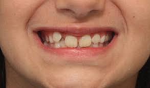 دندان های اضافی و مشکلات دندانپزشکی آن برای کودکان 1 دندان های اضافی