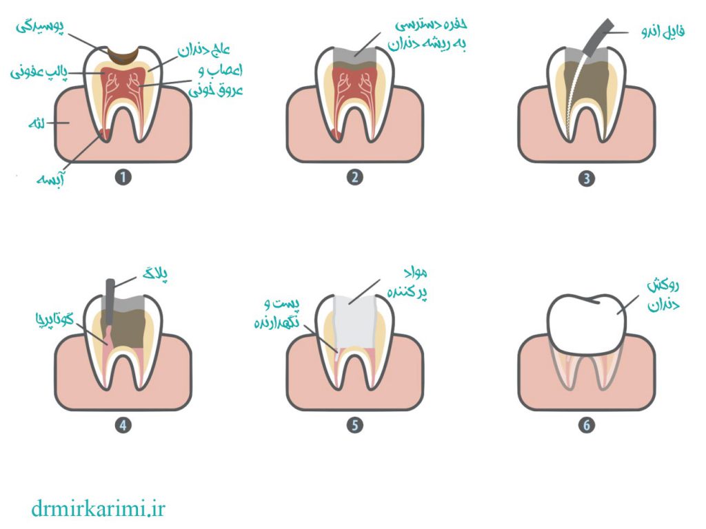 نحوه درمان ریشه دندان