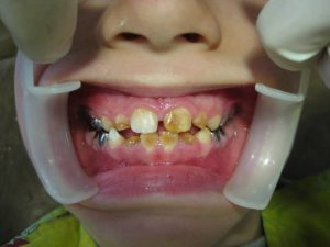 آملوژنز ایمپرفکتا دندانهای شیری و دائمی را درگیر میکند