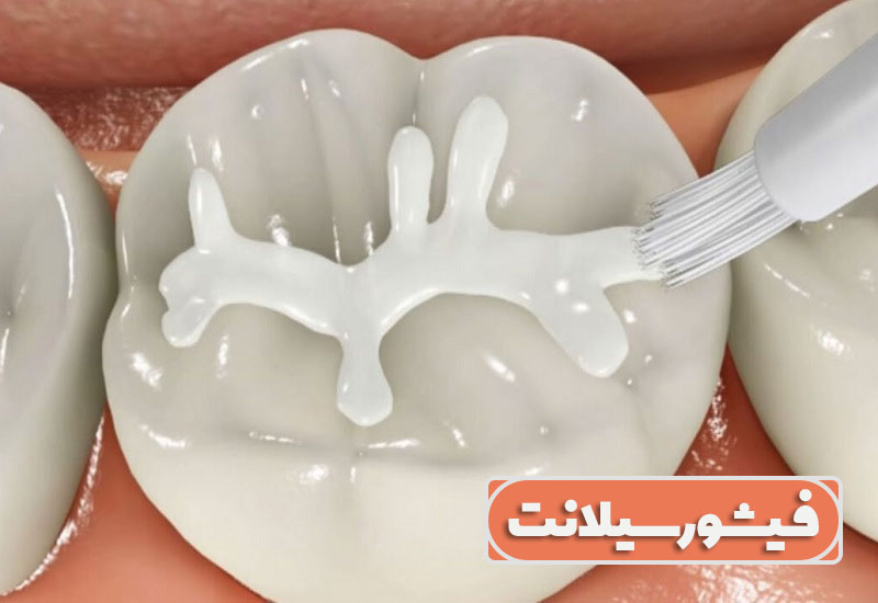 مراقبت های لازم پس از درمان فیشورسیلنت 1 فیشورسیلانت
