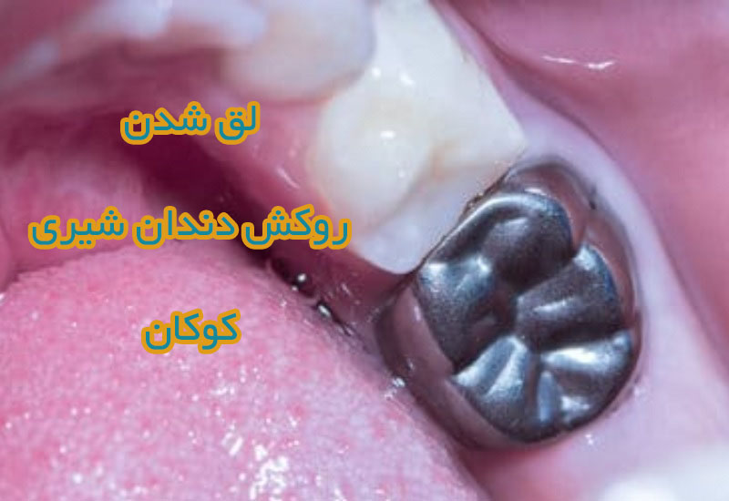 لق شدن روکش دندان شیری 1 لق شدن روکش دندان شیری کودکان