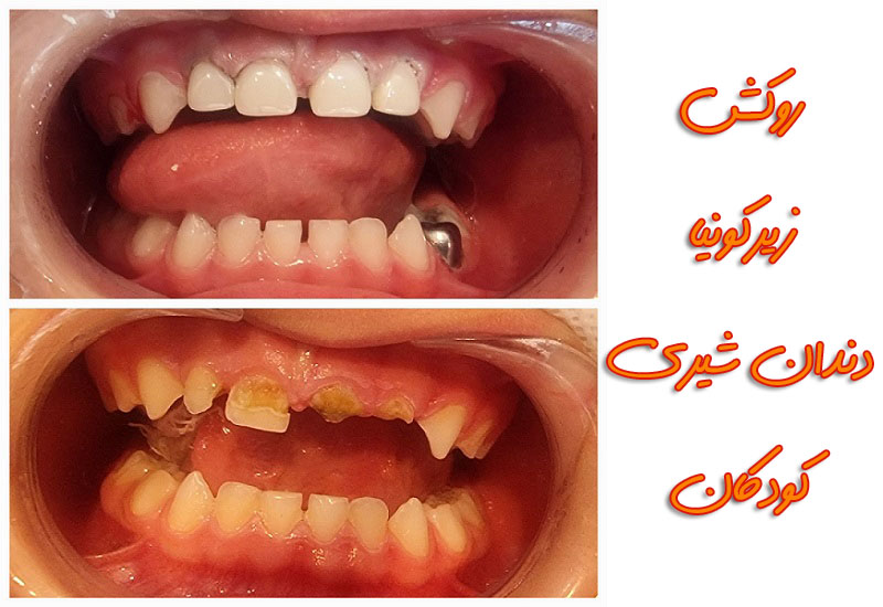 مزایا و معایب روکش دندان شیری زیرکونیا 1 روکش زیرکونیا دندان شیری کودکان
