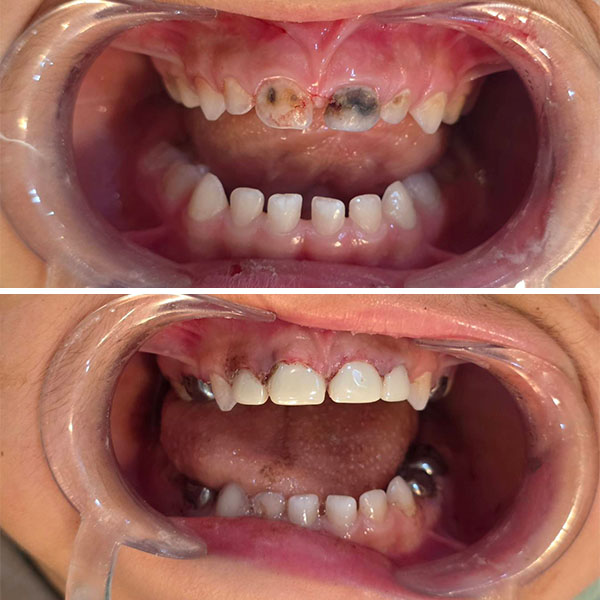 ترمیم دندانهای جلویی شیری با روکش زیرکونیا 1 ترمیم دندانهای جلویی شیری با روکش زیرکونیا 3