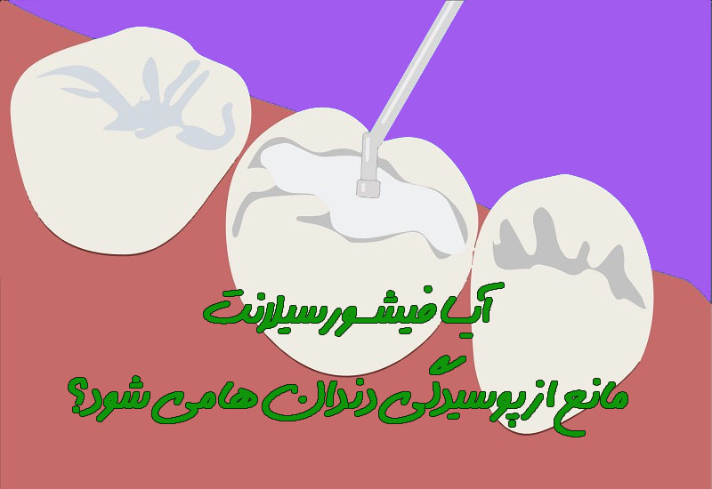 آیا فیشورسیلنت مانع پوسیدگی دندان میشود؟ 1 56465454564654